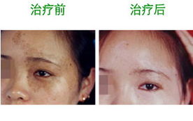 食疗黄褐斑(食疗治疗黄褐斑),第1张 食疗黄褐斑(食疗治疗黄褐斑),食疗黄褐斑(食疗治疗黄褐斑),第1张