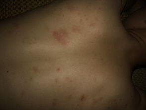 后背皮肤毛囊炎（后背毛囊炎很痒怎么办）,后背皮肤毛囊炎（后背毛囊炎很痒怎么办）,第1张