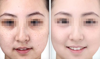 食疗黄褐斑(食疗治疗黄褐斑),第3张 食疗黄褐斑(食疗治疗黄褐斑),食疗黄褐斑(食疗治疗黄褐斑),第3张