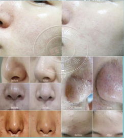 皮肤晒伤剥皮正常么(皮肤晒伤脱皮怎么修复小妙招),第1张 皮肤晒伤剥皮正常么(皮肤晒伤脱皮怎么修复小妙招),皮肤晒伤剥皮正常么(皮肤晒伤脱皮怎么修复小妙招),第1张