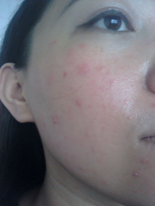 皮肤过敏能用bb(皮肤过敏能用百多邦吗),第2张 皮肤过敏能用bb(皮肤过敏能用百多邦吗),皮肤过敏能用bb(皮肤过敏能用百多邦吗),第2张