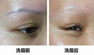 激光洗眉皮肤会烂吗(激光洗眉皮肤有破损正常吗),第2张 激光洗眉皮肤会烂吗(激光洗眉皮肤有破损正常吗),激光洗眉皮肤会烂吗(激光洗眉皮肤有破损正常吗),第2张