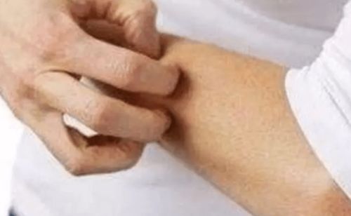 湿疹用什么药（湿疹用什么药治疗最好）,湿疹用什么药（湿疹用什么药治疗最好）,第2张