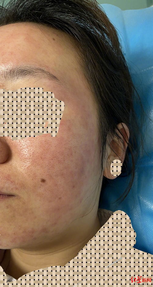 皮肤过敏能用bb(皮肤过敏能用百多邦吗),第3张 皮肤过敏能用bb(皮肤过敏能用百多邦吗),皮肤过敏能用bb(皮肤过敏能用百多邦吗),第3张