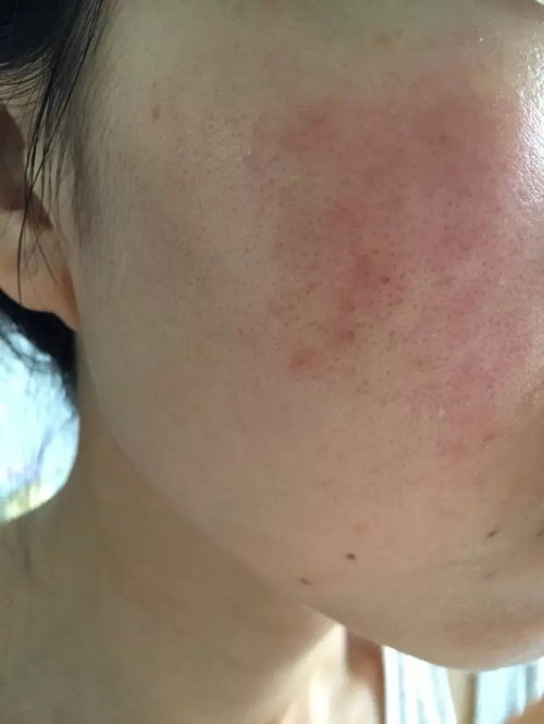 脸上的皮肤像磨砂一样(脸上有块皮肤像磨砂一样),第2张 脸上的皮肤像磨砂一样(脸上有块皮肤像磨砂一样),脸上的皮肤像磨砂一样(脸上有块皮肤像磨砂一样),第2张