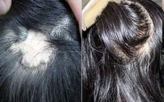 有疤的皮肤能种植毛发吗(疤痕处能不能植发),第1张 有疤的皮肤能种植毛发吗(疤痕处能不能植发),有疤的皮肤能种植毛发吗(疤痕处能不能植发),第1张