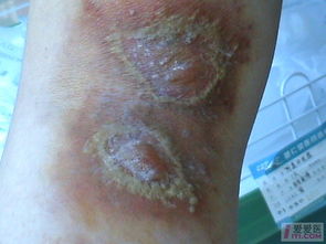 皮肤病图片对照大全查看图片（皮肤病图片对照大全查看图片皮炎）,皮肤病图片对照大全查看图片（皮肤病图片对照大全查看图片皮炎）,第3张