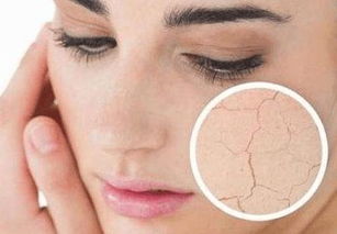 面部有红血丝怎么办(面部有血丝是什么症状),第1张 面部有红血丝怎么办(面部有血丝是什么症状),面部有红血丝怎么办(面部有血丝是什么症状),第1张