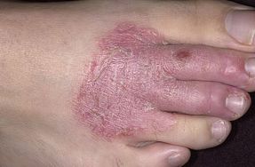 湿疹中药(湿疹中药能彻底治愈吗),第2张 湿疹中药(湿疹中药能彻底治愈吗),湿疹中药(湿疹中药能彻底治愈吗),第2张