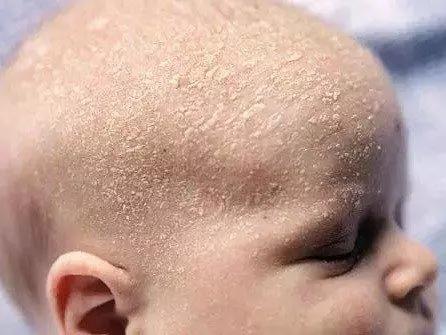 脂溢性皮炎治疗方法(婴儿头顶脂溢性皮炎治疗方法),第3张 脂溢性皮炎治疗方法(婴儿头顶脂溢性皮炎治疗方法),脂溢性皮炎治疗方法(婴儿头顶脂溢性皮炎治疗方法),第3张