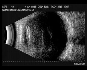 眼睛玻璃体混浊症状(请问眼睛玻璃体混浊是由什么引起的),第1张 眼睛玻璃体混浊症状(请问眼睛玻璃体混浊是由什么引起的),眼睛玻璃体混浊症状(请问眼睛玻璃体混浊是由什么引起的),第1张