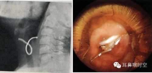 米粒q（米粒呛到气管里咳不出来怎么办）,米粒q（米粒呛到气管里咳不出来怎么办）,第1张