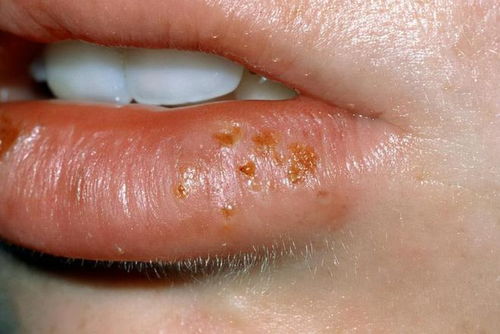 嘴角起泡上火如何快速消除(哺乳期嘴角起泡上火如何快速消除),第3张 嘴角起泡上火如何快速消除(哺乳期嘴角起泡上火如何快速消除),嘴角起泡上火如何快速消除(哺乳期嘴角起泡上火如何快速消除),第3张