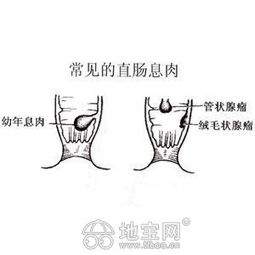 肠(肠息肉的主要症状有哪些),第2张 肠(肠息肉的主要症状有哪些),肠(肠息肉的主要症状有哪些),第2张