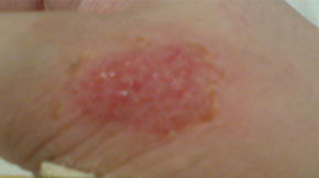 治疗湿疹的药有哪些（治疗湿疹的药有哪些效果好）,治疗湿疹的药有哪些（治疗湿疹的药有哪些效果好）,第1张