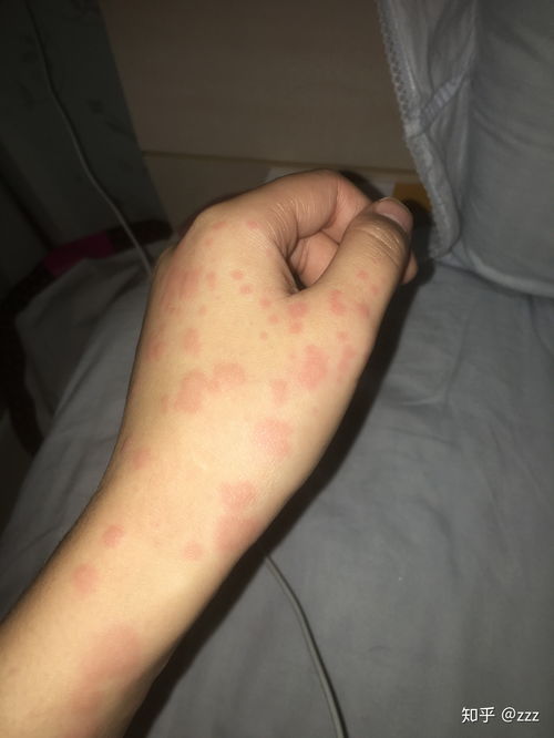 荨麻疹吃什么（荨麻疹吃什么药见效最快）,荨麻疹吃什么（荨麻疹吃什么药见效最快）,第3张