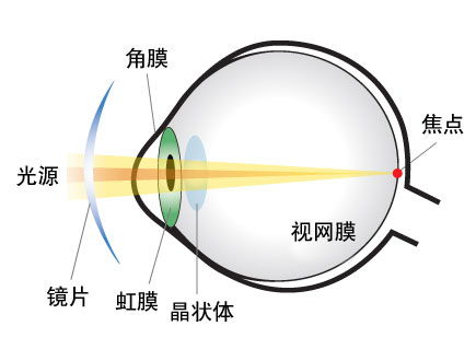 眼睛散光是怎么回事（成人眼睛散光是怎么回事）,眼睛散光是怎么回事（成人眼睛散光是怎么回事）,第1张