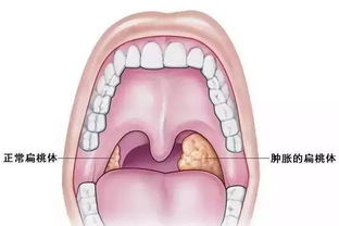 孕妇怎么去火(孕妇怎么去火,嗓子发炎),第2张 孕妇怎么去火(孕妇怎么去火,嗓子发炎),孕妇怎么去火(孕妇怎么去火,嗓子发炎),第2张