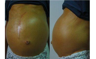 肝硬化腹水症状(肝硬化腹水症状表现有哪些图片),第2张 肝硬化腹水症状(肝硬化腹水症状表现有哪些图片),肝硬化腹水症状(肝硬化腹水症状表现有哪些图片),第2张