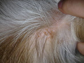 荨麻疹吃什么（荨麻疹吃什么药见效最快）,荨麻疹吃什么（荨麻疹吃什么药见效最快）,第2张