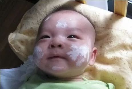 治疗湿疹的药有哪些（治疗湿疹的药有哪些效果好）,治疗湿疹的药有哪些（治疗湿疹的药有哪些效果好）,第3张