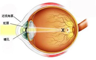 眼睛散光是怎么回事（成人眼睛散光是怎么回事）,眼睛散光是怎么回事（成人眼睛散光是怎么回事）,第2张