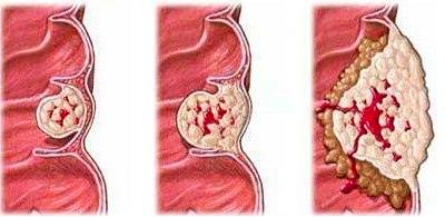 肠(肠息肉的主要症状有哪些),第3张 肠(肠息肉的主要症状有哪些),肠(肠息肉的主要症状有哪些),第3张